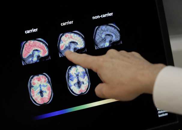 Here’s why we approved the first new Alzheimer’s drug in two decades